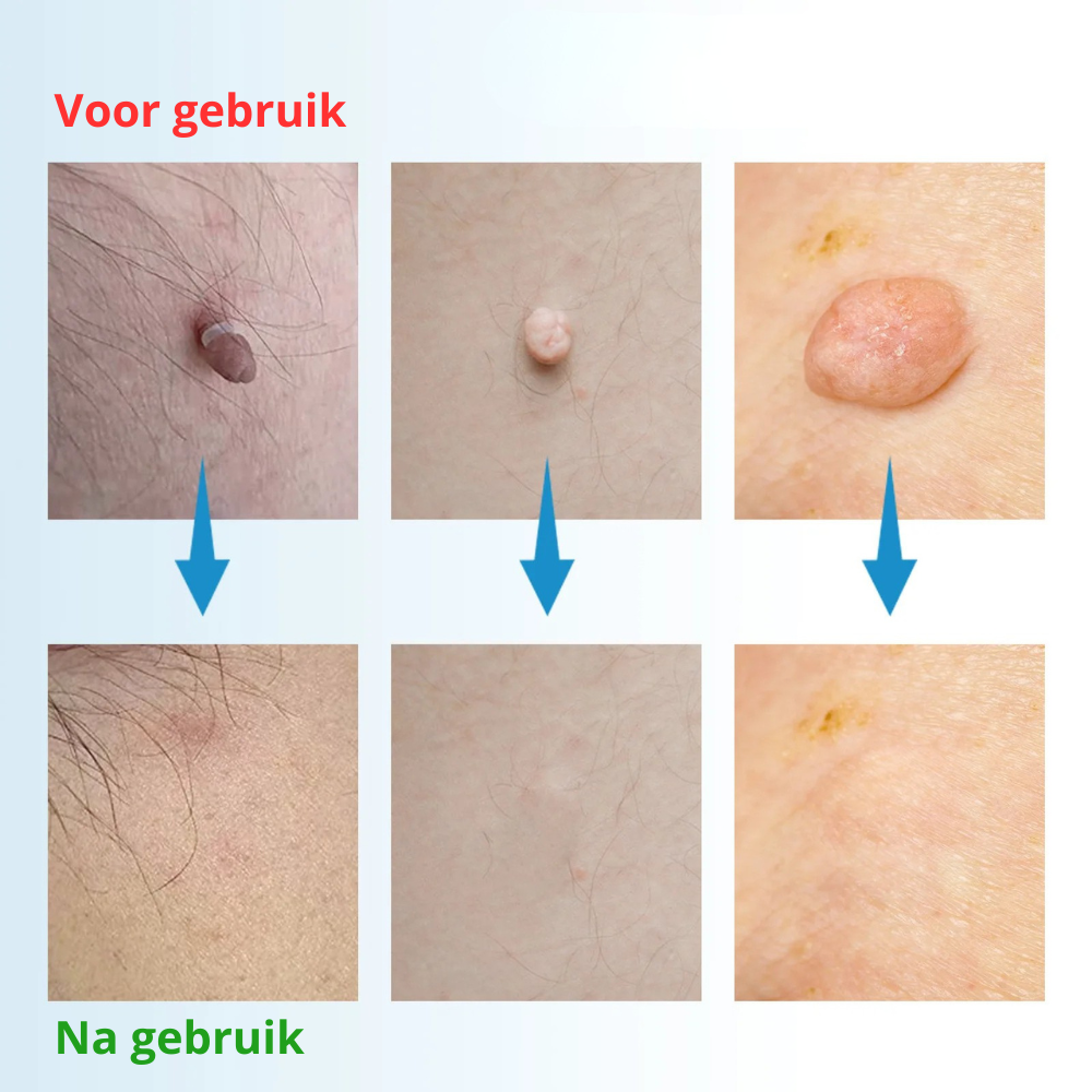 RestoreSkin™  | Pijnloos & effectief!
